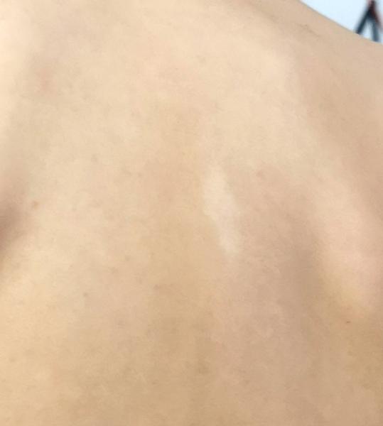 Bild zu Vitiligo - Haut von Babys und Kindern ✔️ Expertenforum
