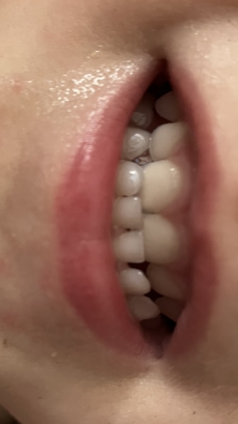 Bild zu Sonnenstift Lippe - Haut von Babys und Kindern ✔️ Expertenforum
