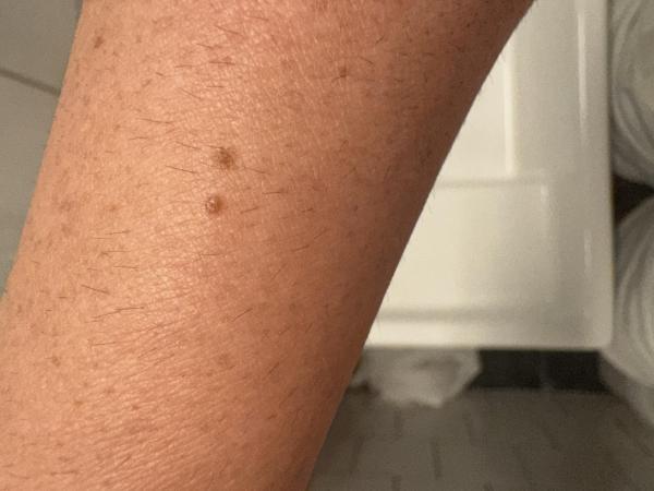 Bild zu Fotos zur vorherigen Frage - Haut von Babys und Kindern ✔️ Expertenforum