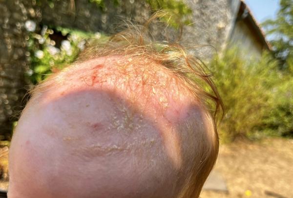 Bild zu Gneis, Milchschorf oder Ekzeme? - Haut von Babys und Kindern ✔️ Expertenforum