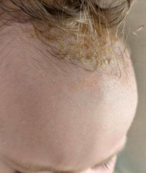 Bild zu Ausschlag Hals und Hautveränderung Stirn - Haut von Babys und Kindern ✔️ Expertenforum