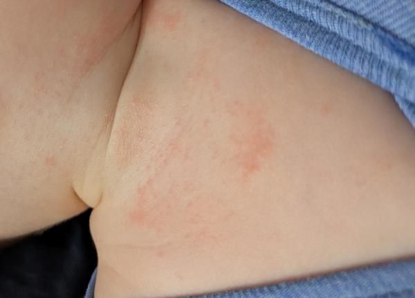 Bild zu Ausschlag Hals und Hautveränderung Stirn - Haut von Babys und Kindern ✔️ Expertenforum