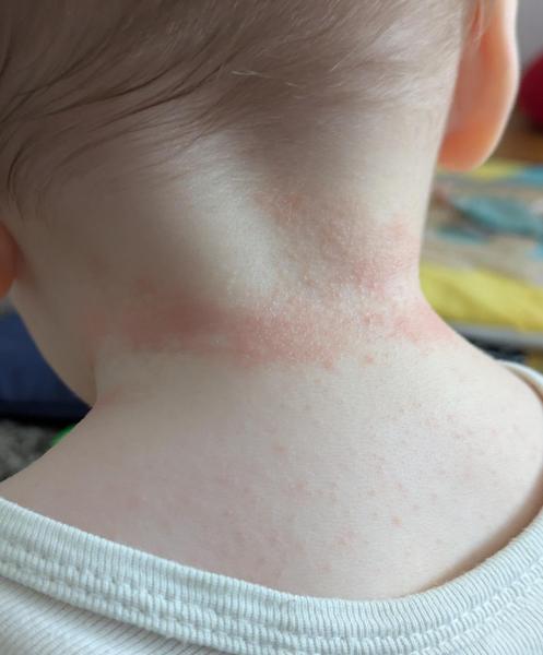 Bild zu Ausschlag Hals und Hautveränderung Stirn - Haut von Babys und Kindern ✔️ Expertenforum
