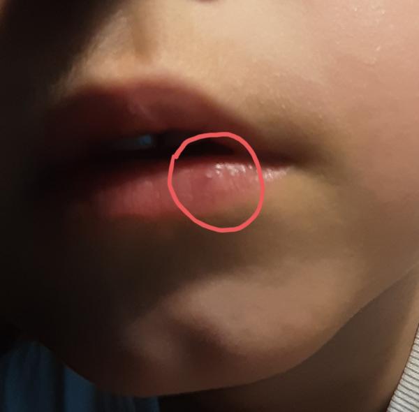 Bild zu Punkt auf Lippe und nicht immer Rötung nach Zeckenbiss - Haut von Babys und Kindern ✔️ Expertenforum