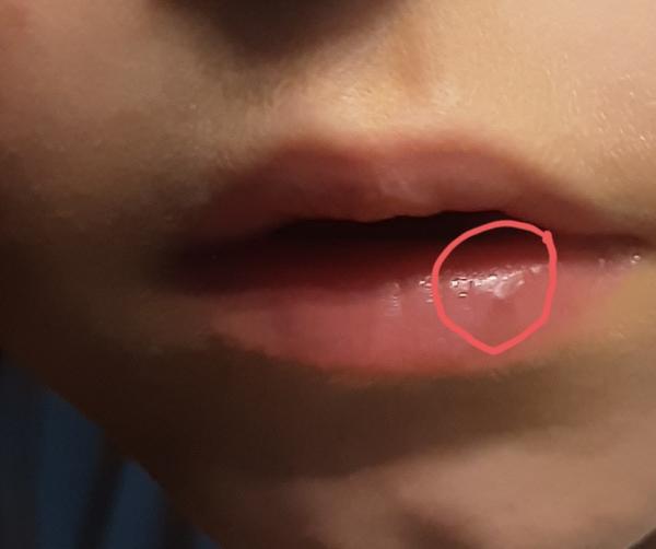 Bild zu Punkt auf Lippe und nicht immer Rötung nach Zeckenbiss - Haut von Babys und Kindern ✔️ Expertenforum