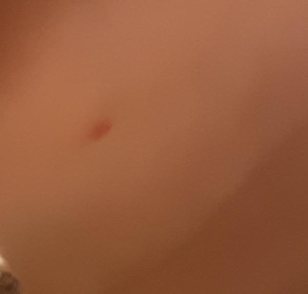 Bild zu Punkt auf Lippe und nicht immer Rötung nach Zeckenbiss - Haut von Babys und Kindern ✔️ Expertenforum