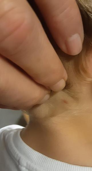 Bild zu Punkt auf Lippe und nicht immer Rötung nach Zeckenbiss - Haut von Babys und Kindern ✔️ Expertenforum