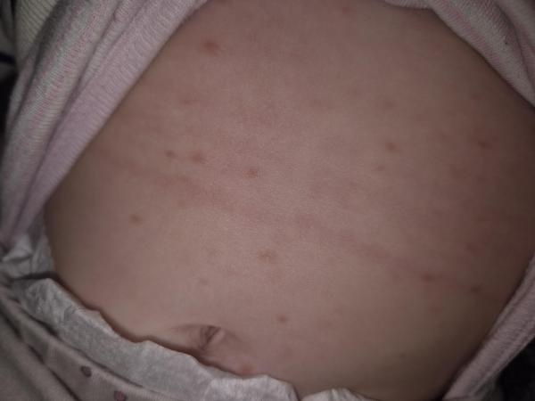 Bild zu Roter Auschlag Baby 7 Monate - Haut von Babys und Kindern ✔️ Expertenforum