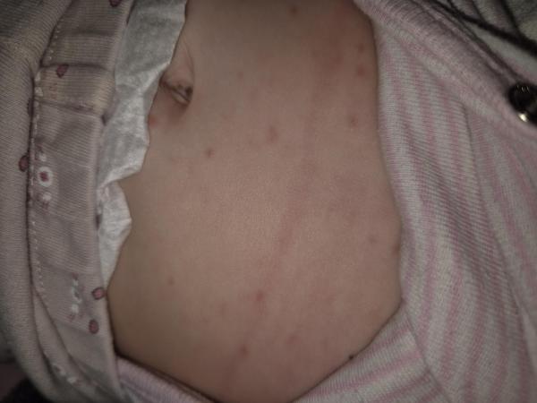 Bild zu Roter Auschlag Baby 7 Monate - Haut von Babys und Kindern ✔️ Expertenforum