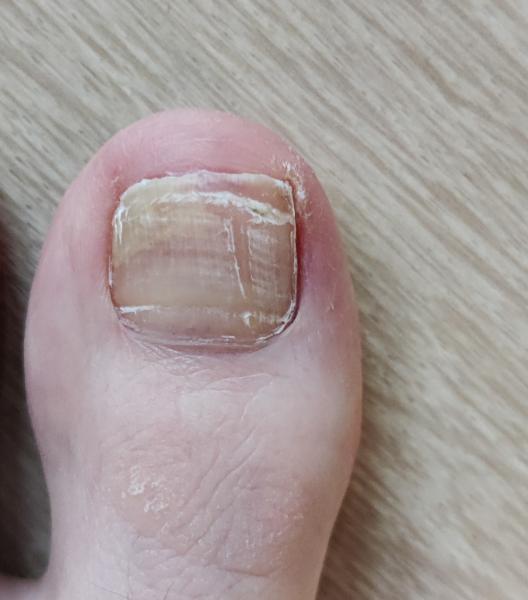 Bild zu Nachfrage Nagelpilz - Haut von Babys und Kindern ✔️ Expertenforum
