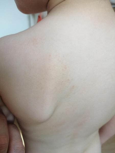 Bild zu Juckender Hautausschlag - Haut von Babys und Kindern ✔️ Expertenforum
