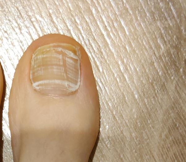 Bild zu Nagelpilz - Haut von Babys und Kindern ✔️ Expertenforum