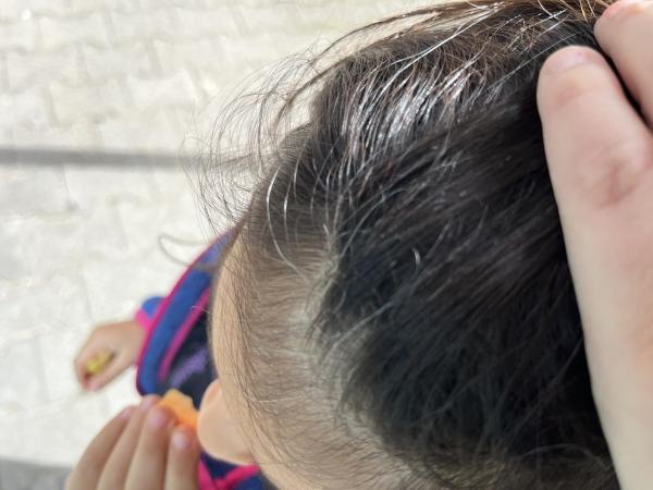 Bild zu Weiße Haare bei Kleinkind - Haut von Babys und Kindern ✔️ Expertenforum