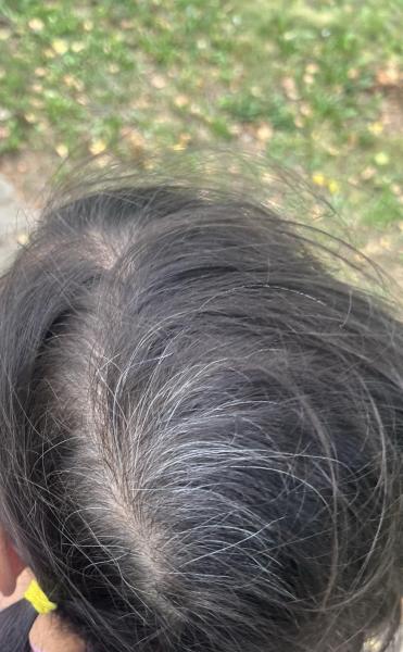 Bild zu Weiße Haare bei Kleinkind - Haut von Babys und Kindern ✔️ Expertenforum