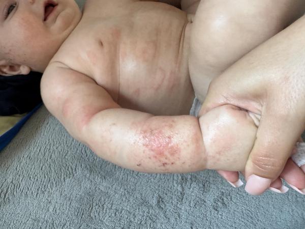 Bild zu Akute Neurodermitis - Haut von Babys und Kindern ✔️ Expertenforum