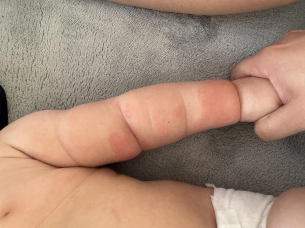 Bild zu Akute Neurodermitis - Haut von Babys und Kindern ✔️ Expertenforum