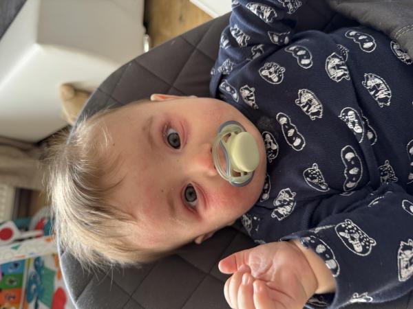 Bild zu Starke Neurodermitis - Haut von Babys und Kindern ✔️ Expertenforum