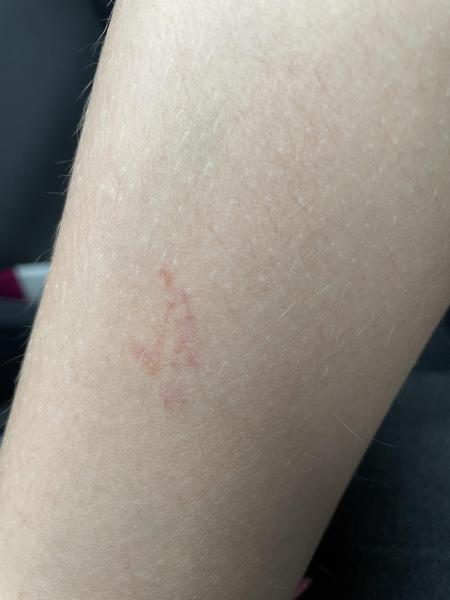Bild zu Scabies - Haut von Babys und Kindern ✔️ Expertenforum