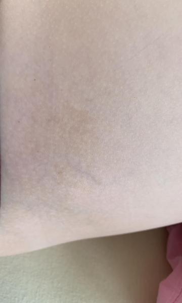 Bild zu Zusatz nf1 - Haut von Babys und Kindern ✔️ Expertenforum