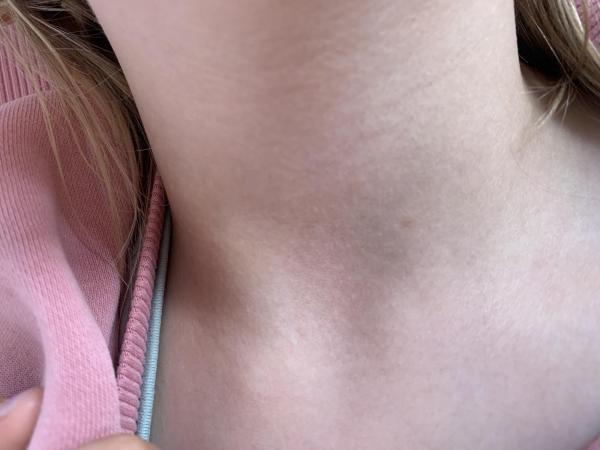 Bild zu Zusatz nf1 - Haut von Babys und Kindern ✔️ Expertenforum
