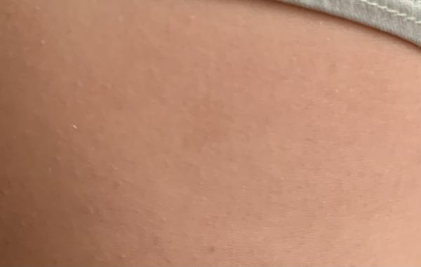 Bild zu Zusatz nf1 - Haut von Babys und Kindern ✔️ Expertenforum