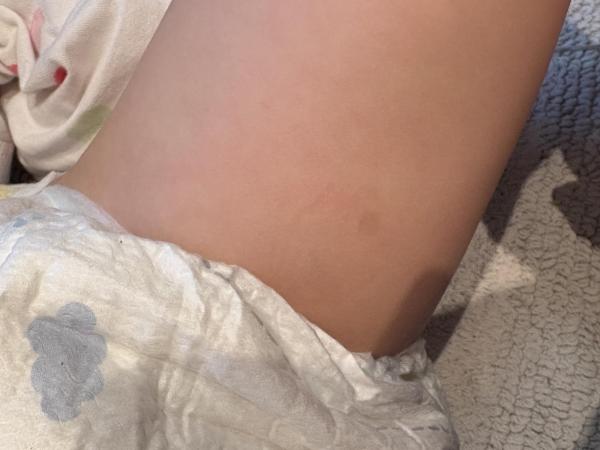Bild zu Angst vor NF1 - Haut von Babys und Kindern ✔️ Expertenforum