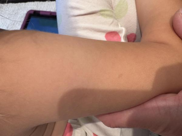 Bild zu Angst vor NF1 - Haut von Babys und Kindern ✔️ Expertenforum