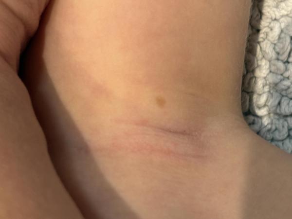 Bild zu Angst vor NF1 - Haut von Babys und Kindern ✔️ Expertenforum