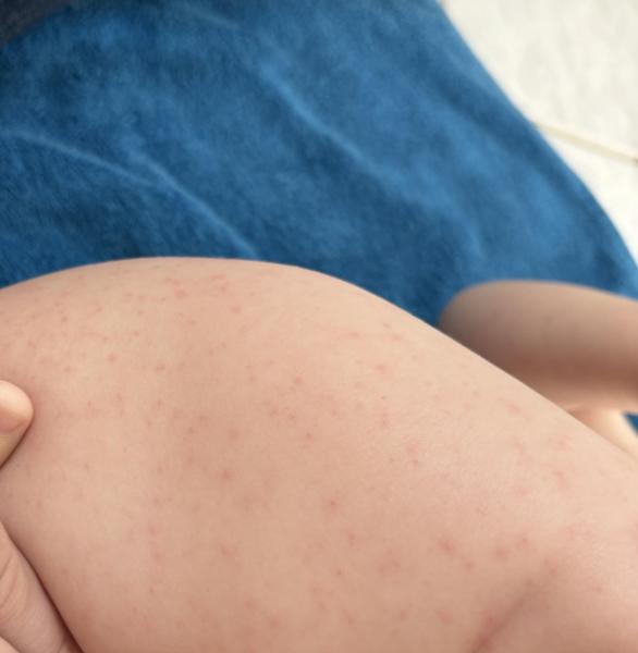 Bild zu Hautausschlag - Haut von Babys und Kindern ✔️ Expertenforum