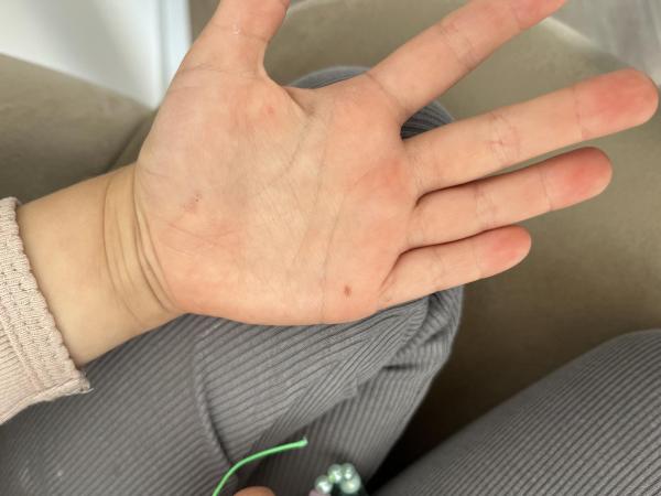 Bild zu Muttermale in der Kindheit - Haut von Babys und Kindern ✔️ Expertenforum