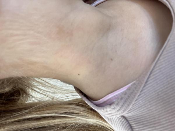 Bild zu Muttermale in der Kindheit - Haut von Babys und Kindern ✔️ Expertenforum