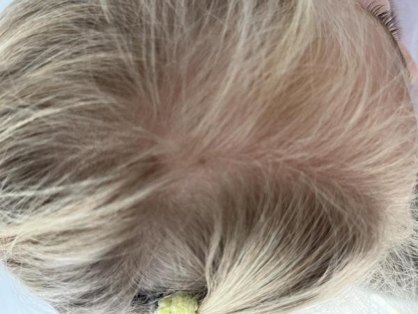 Bild zu Muttermale in der Kindheit - Haut von Babys und Kindern ✔️ Expertenforum