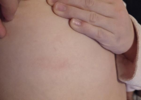 Bild zu Rote Flecken - Haut von Babys und Kindern ✔️ Expertenforum