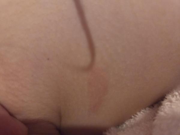 Bild zu Rote Flecken - Haut von Babys und Kindern ✔️ Expertenforum
