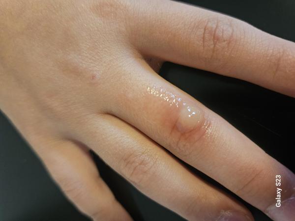 Bild zu Blase am Finger - Haut von Babys und Kindern ✔️ Expertenforum