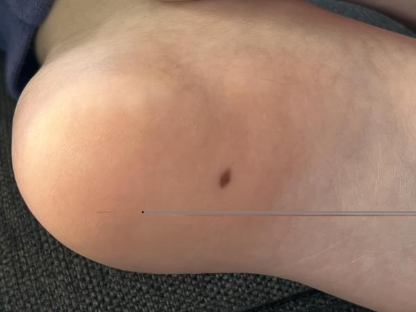 Bild zu Schnell gewachsenes Muttermal - Haut von Babys und Kindern ✔️ Expertenforum