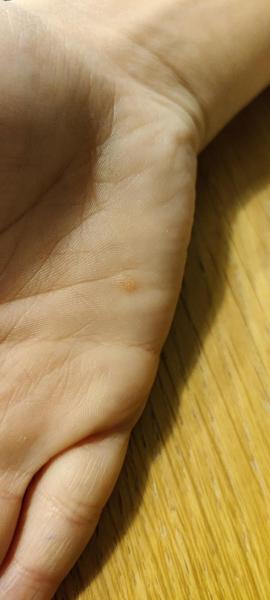 Bild zu Warze Hand - Haut von Babys und Kindern ✔️ Expertenforum