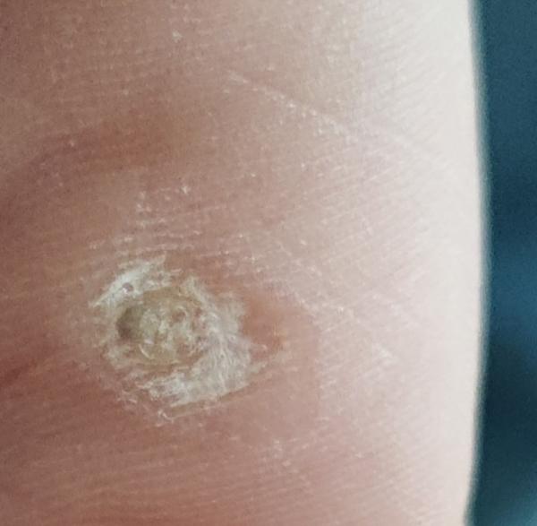 Bild zu Warzenbehandlung - Haut von Babys und Kindern ✔️ Expertenforum