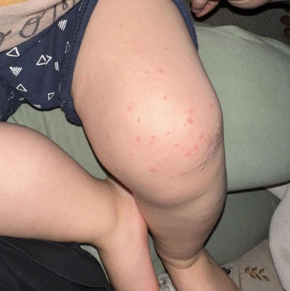 Bild zu Ausschlag bei Kleinkind - Haut von Babys und Kindern ✔️ Expertenforum