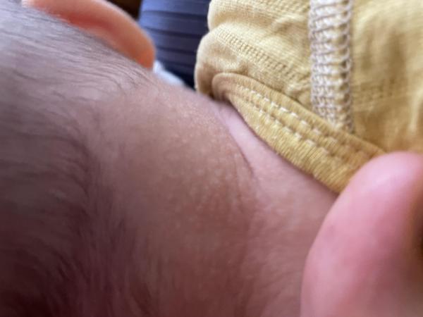 Bild zu Undefinierbarer Hautausschlag Baby 4 Monate - Haut von Babys und Kindern ✔️ Expertenforum