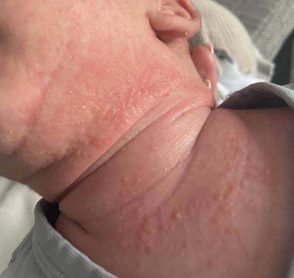 Bild zu Baby 1 Monat alt - Haut von Babys und Kindern ✔️ Expertenforum