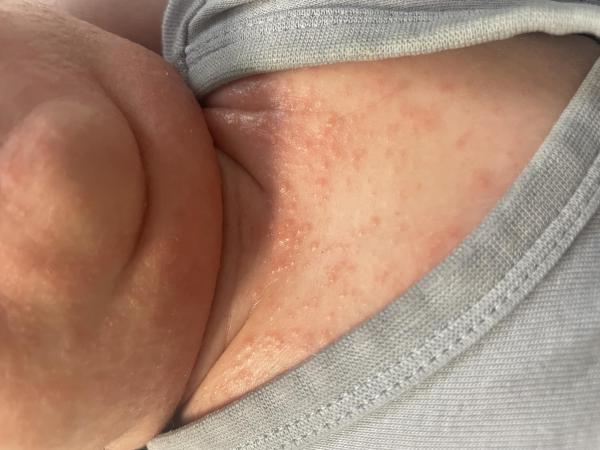 Bild zu Baby 1 Monat alt - Haut von Babys und Kindern ✔️ Expertenforum