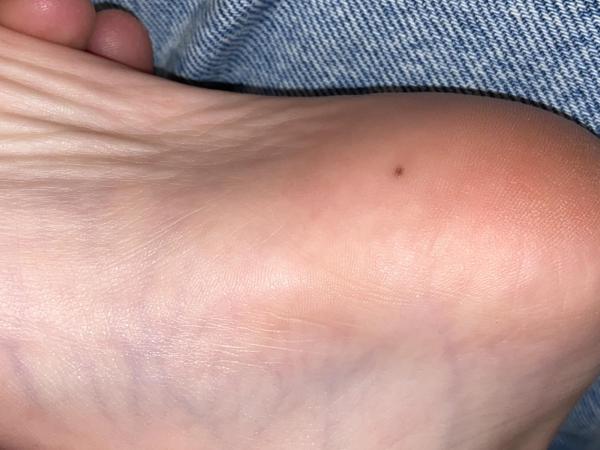 Bild zu Schnell gewachsenes Muttermal - Haut von Babys und Kindern ✔️ Expertenforum