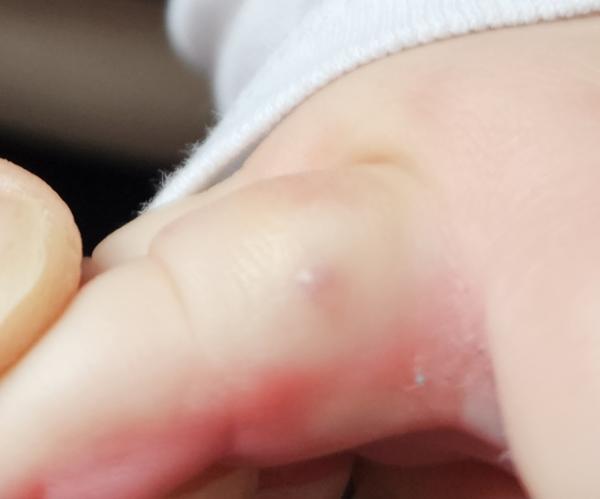 Bild zu Pickel seit Geburt - Haut von Babys und Kindern ✔️ Expertenforum