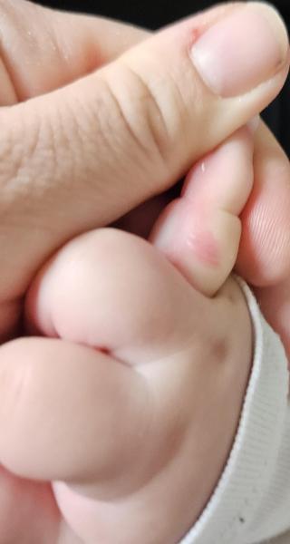 Bild zu Zusatz Pickel seit Geburt - Haut von Babys und Kindern ✔️ Expertenforum