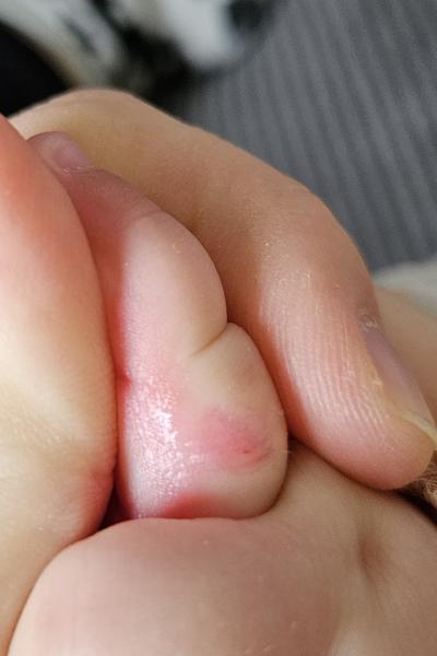 Bild zu Zusatz Pickel seit Geburt - Haut von Babys und Kindern ✔️ Expertenforum