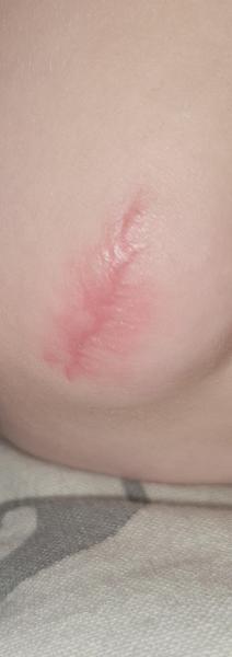 Bild zu Platzwunde 4 Wochen alt - Narbenheilung - Haut von Babys und Kindern ✔️ Expertenforum