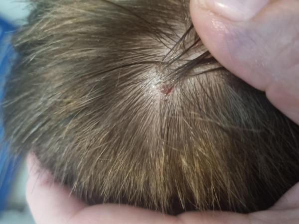 Bild zu Muttermal oder Kratzstelle am Kopf - Haut von Babys und Kindern ✔️ Expertenforum