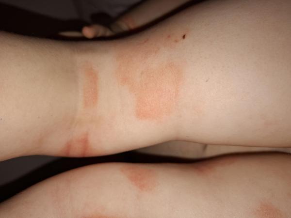 Bild zu Neurodermitis oder Pilzbefall - Haut von Babys und Kindern ✔️ Expertenforum