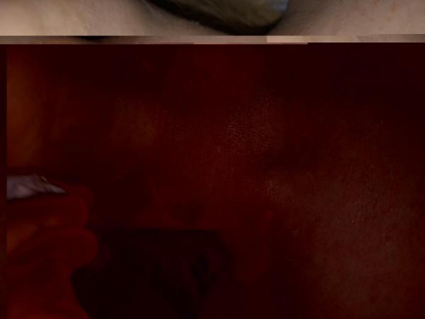 Bild zu Neurodermitis oder Pilzbefall - Haut von Babys und Kindern ✔️ Expertenforum